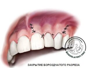 резекция корня показания