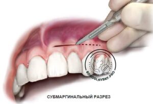 субмаргинальный разрез апексэктомия